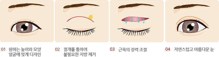 눈매교정술